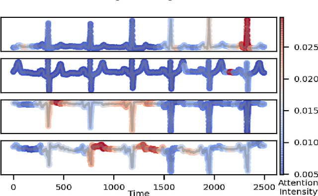 Figure 4 for Hierarchical Transformer for Electrocardiogram Diagnosis