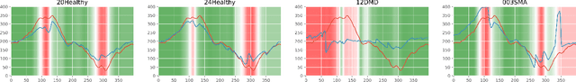 Figure 4 for Shape Analysis for Pediatric Upper Body Motor Function Assessment