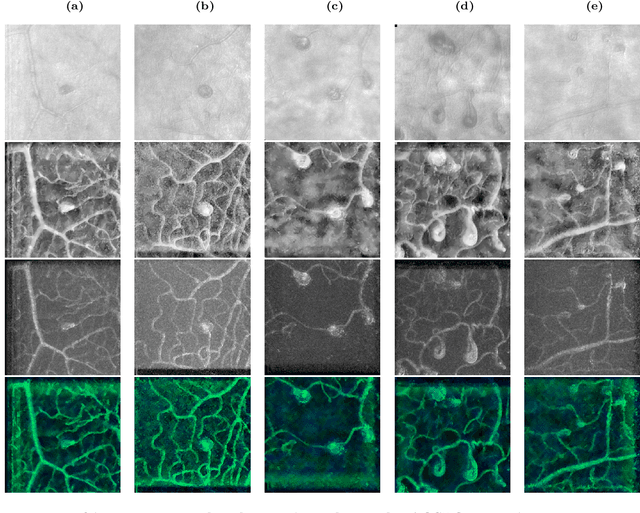 Figure 1 for AOSLO-net: A deep learning-based method for automatic segmentation of retinal microaneurysms from adaptive optics scanning laser ophthalmoscope images