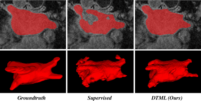 Figure 4 for Dual-Task Mutual Learning for Semi-Supervised Medical Image Segmentation