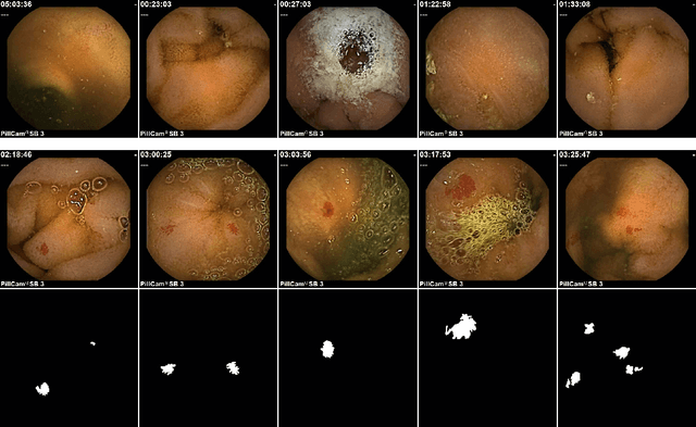 Figure 1 for Angiodysplasia Detection and Localization Using Deep Convolutional Neural Networks