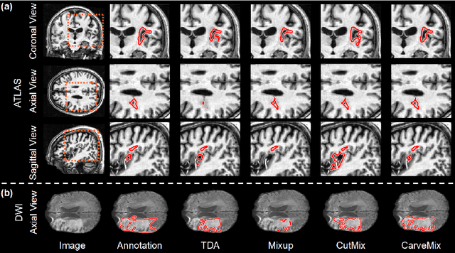 Figure 3 for CarveMix: A Simple Data Augmentation Method for Brain Lesion Segmentation