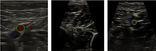 Figure 1 for Automatic ultrasound vessel segmentation with deep spatiotemporal context learning