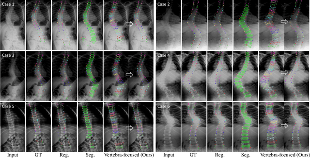 Figure 4 for Vertebra-Focused Landmark Detection for Scoliosis Assessment
