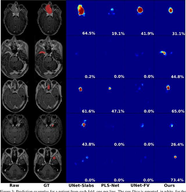 Figure 3 for Meningioma segmentation in T1-weighted MRI leveraging global context and attention mechanisms