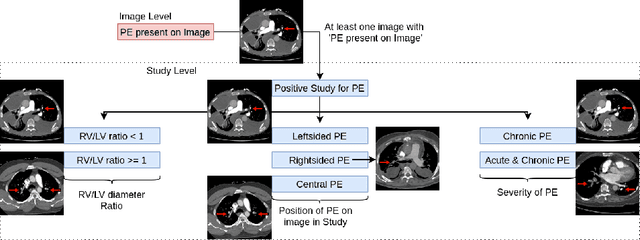 Figure 3 for Attention based CNN-LSTM Network for Pulmonary Embolism Prediction on Chest Computed Tomography Pulmonary Angiograms