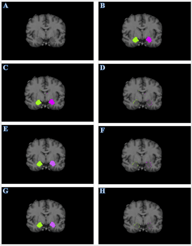 Figure 2 for Accurate Automatic Segmentation of Amygdala Subnuclei and Modeling of Uncertainty via Bayesian Fully Convolutional Neural Network