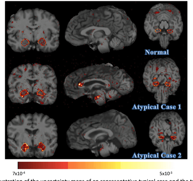 Figure 4 for Accurate Automatic Segmentation of Amygdala Subnuclei and Modeling of Uncertainty via Bayesian Fully Convolutional Neural Network