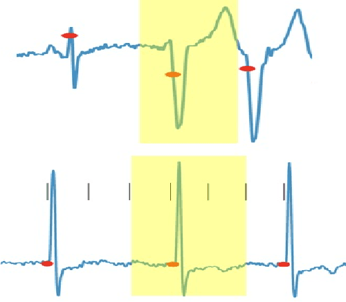 Figure 3 for False arrhythmia alarm reduction in the intensive care unit