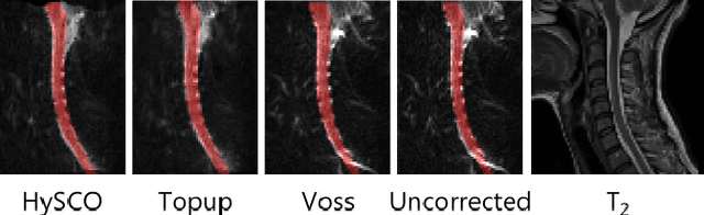 Figure 3 for Evaluation of distortion correction methods in diffusion MRI of the spinal cord