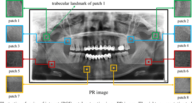 Figure 1 for Osteoporosis Prescreening using Panoramic Radiographs through a Deep Convolutional Neural Network with Attention Mechanism
