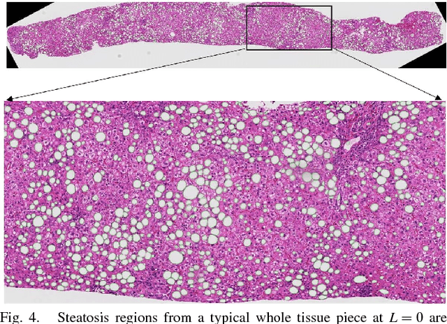 Figure 4 for Segmentation of Overlapped Steatosis in Whole-Slide Liver Histopathology Microscopy Images