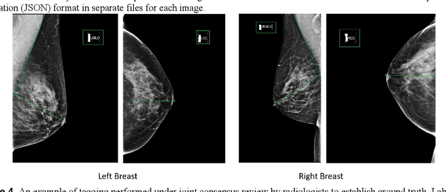 Figure 4 for Deep Learning-Based Automatic Detection of Poorly Positioned Mammograms to Minimize Patient Return Visits for Repeat Imaging: A Real-World Application