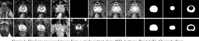Figure 1 for Deep Learning for fully automatic detection, segmentation, and Gleason Grade estimation of prostate cancer in multiparametric Magnetic Resonance Images