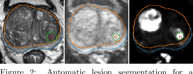 Figure 3 for Deep Learning for fully automatic detection, segmentation, and Gleason Grade estimation of prostate cancer in multiparametric Magnetic Resonance Images