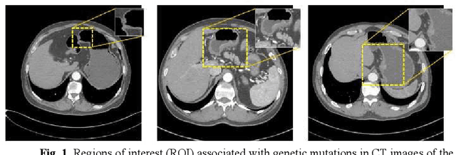 Figure 1 for Pyramid Focusing Network for mutation prediction and classification in CT images