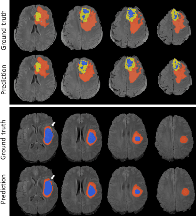 Figure 3 for Brain tumour segmentation using a triplanar ensemble of U-Nets