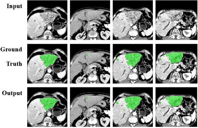 Figure 3 for A New Three-stage Curriculum Learning Approach to Deep Network Based Liver Tumor Segmentation