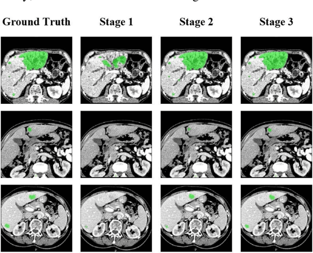 Figure 4 for A New Three-stage Curriculum Learning Approach to Deep Network Based Liver Tumor Segmentation