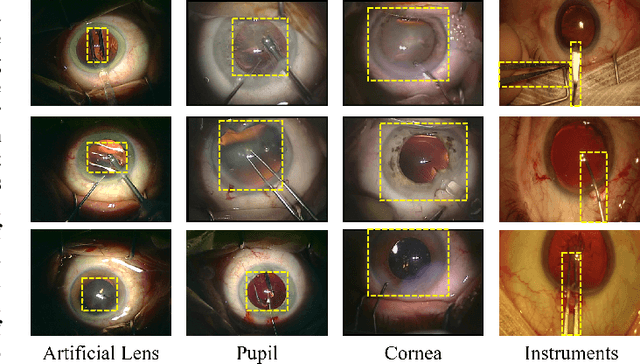 Figure 1 for DeepPyram: Enabling Pyramid View and Deformable Pyramid Reception for Semantic Segmentation in Cataract Surgery Videos