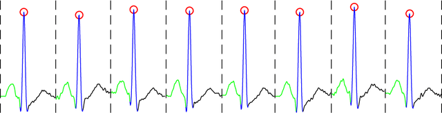 Figure 1 for HAN-ECG: An Interpretable Atrial Fibrillation Detection Model Using Hierarchical Attention Networks