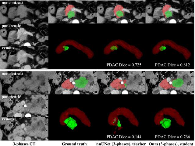 Figure 3 for Robust Pancreatic Ductal Adenocarcinoma Segmentation with Multi-Institutional Multi-Phase Partially-Annotated CT Scans