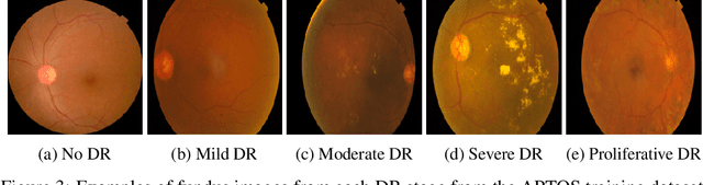 Figure 4 for Convolutional Nets for Diabetic Retinopathy Screening in Bangladeshi Patients