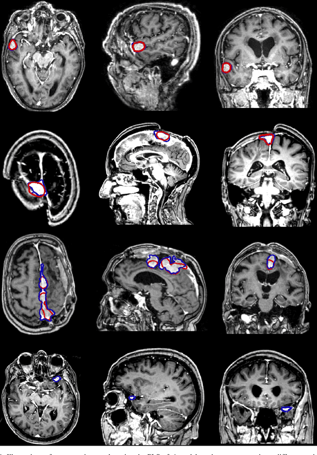 Figure 4 for Fast meningioma segmentation in T1-weighted MRI volumes using a lightweight 3D deep learning architecture