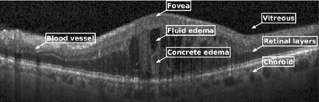 Figure 2 for Cystoid macular edema segmentation of Optical Coherence Tomography images using fully convolutional neural networks and fully connected CRFs