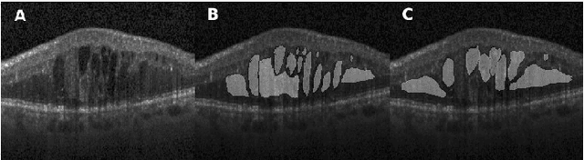 Figure 3 for Cystoid macular edema segmentation of Optical Coherence Tomography images using fully convolutional neural networks and fully connected CRFs