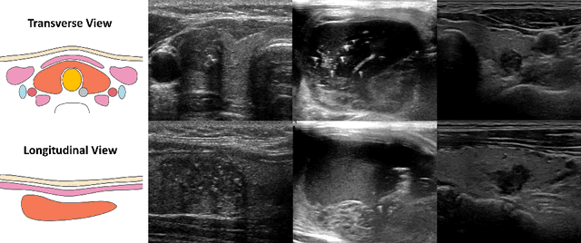 Figure 1 for Personalized Diagnostic Tool for Thyroid Cancer Classification using Multi-view Ultrasound