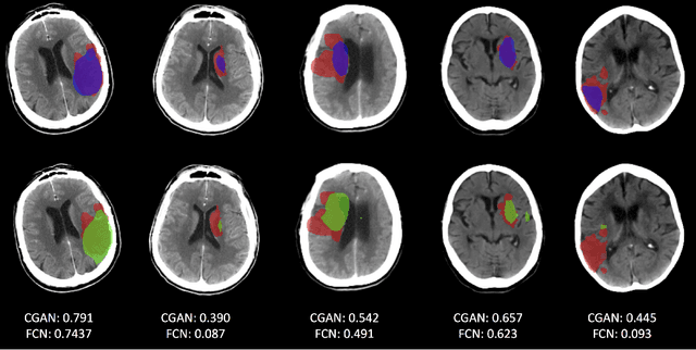 Figure 3 for CT-To-MR Conditional Generative Adversarial Networks for Ischemic Stroke Lesion Segmentation