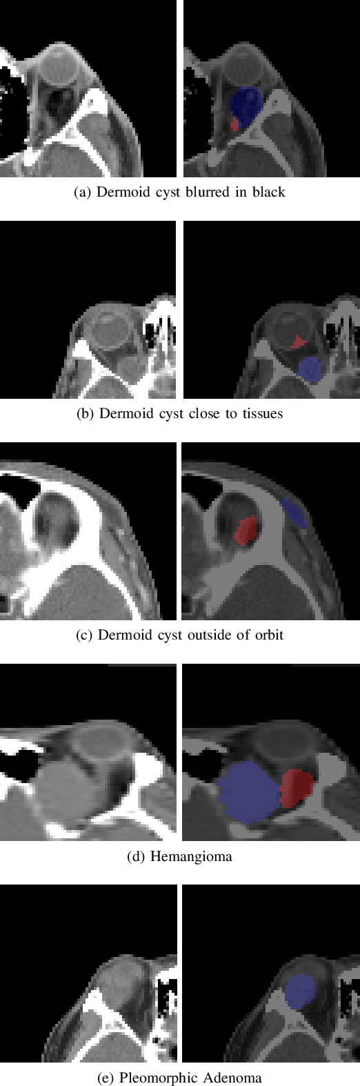 Figure 4 for Supervised Segmentation with Domain Adaptation for Small Sampled Orbital CT Images