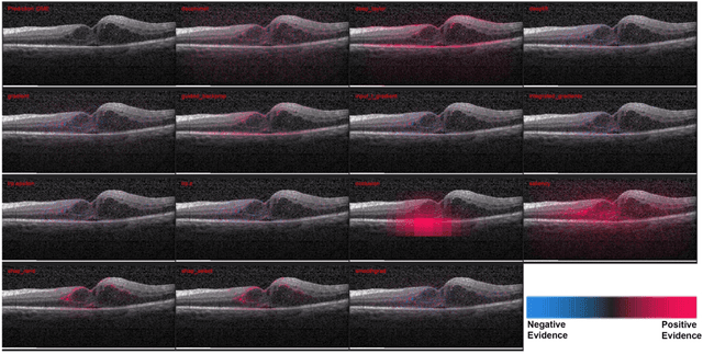 Figure 4 for Quantitative and Qualitative Evaluation of Explainable Deep Learning Methods for Ophthalmic Diagnosis