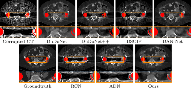 Figure 3 for U-DuDoNet: Unpaired dual-domain network for CT metal artifact reduction