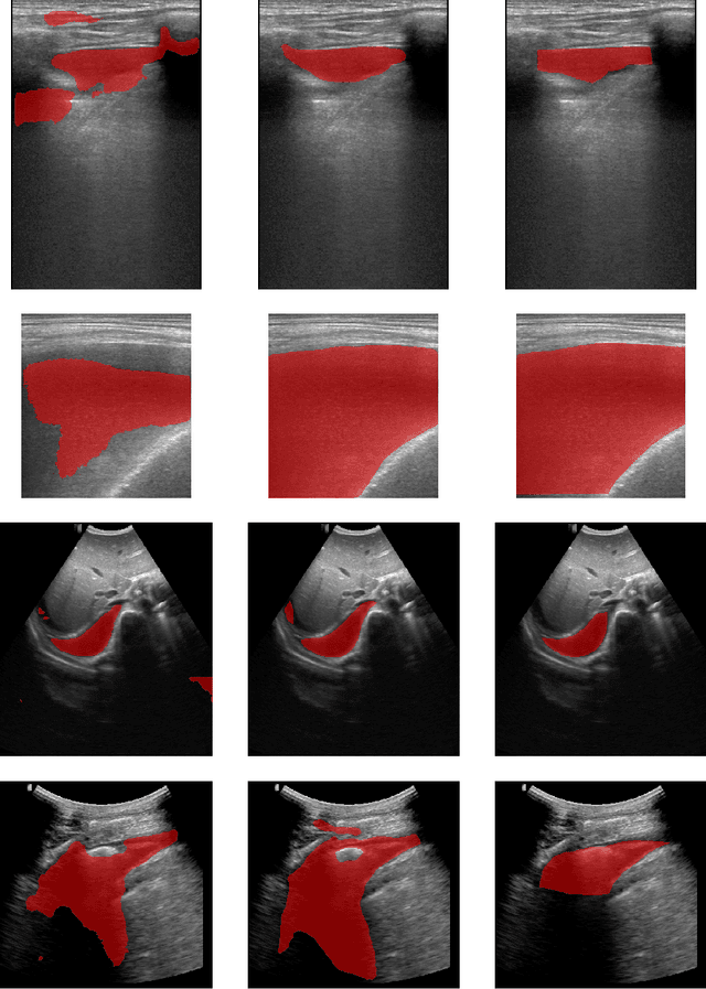 Figure 4 for Deep Learning-based Segmentation of Pleural Effusion From Ultrasound Using Coordinate Convolutions