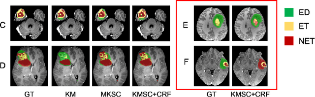 Figure 4 for Scribble-based Hierarchical Weakly Supervised Learning for Brain Tumor Segmentation