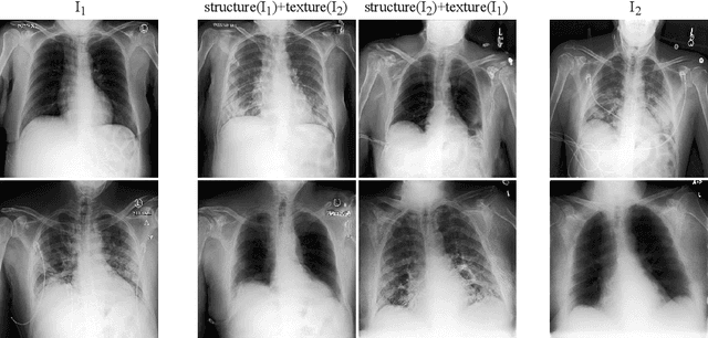 Figure 1 for Lung Swapping Autoencoder: Learning a Disentangled Structure-texture Representation of Chest Radiographs