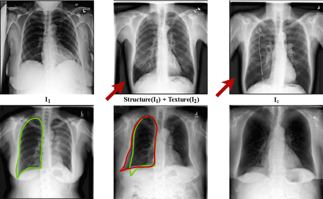 Figure 3 for Lung Swapping Autoencoder: Learning a Disentangled Structure-texture Representation of Chest Radiographs