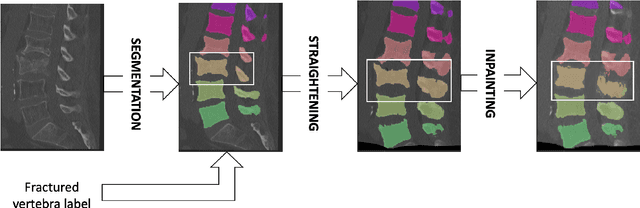 Figure 1 for Patient-specific virtual spine straightening and vertebra inpainting: An automatic framework for osteoplasty planning