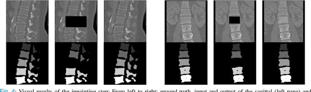 Figure 4 for Patient-specific virtual spine straightening and vertebra inpainting: An automatic framework for osteoplasty planning