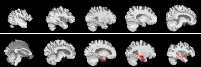 Figure 3 for Explainable Deep CNNs for MRI-Based Diagnosis of Alzheimer's Disease