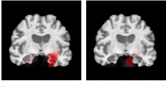Figure 4 for Explainable Deep CNNs for MRI-Based Diagnosis of Alzheimer's Disease