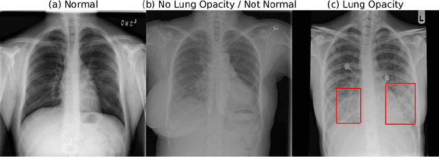 Figure 2 for Deep Learning for Automatic Pneumonia Detection