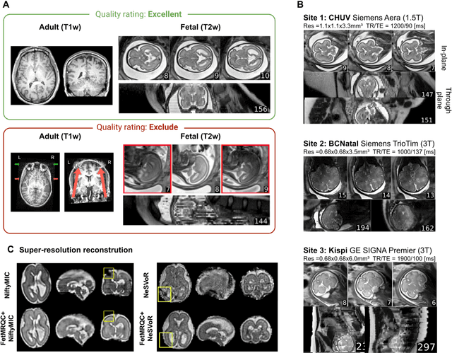 Figure 1 for FetMRQC: an open-source machine learning framework for multi-centric fetal brain MRI quality control