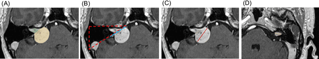 Figure 1 for A Clinical Guideline Driven Automated Linear Feature Extraction for Vestibular Schwannoma