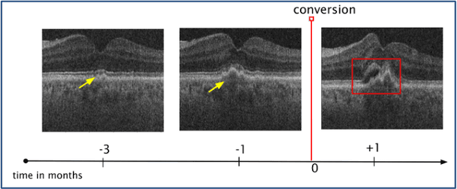 Figure 1 for 3DTINC: Time-Equivariant Non-Contrastive Learning for Predicting Disease Progression from Longitudinal OCTs