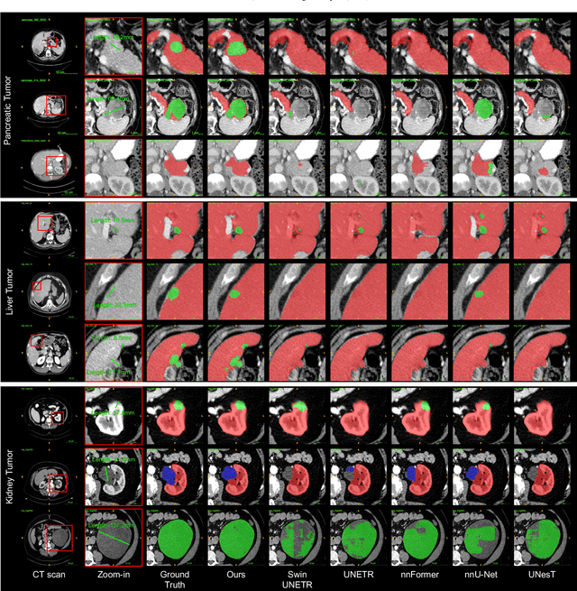 Figure 4 for Universal and Extensible Language-Vision Models for Organ Segmentation and Tumor Detection from Abdominal Computed Tomography