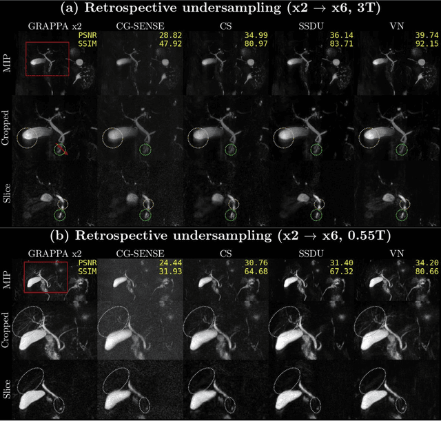 Figure 3 for Accelerated MR Cholangiopancreatography with Deep Learning-based Reconstruction