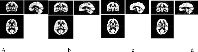 Figure 1 for Introducing an ensemble method for the early detection of Alzheimer's disease through the analysis of PET scan images